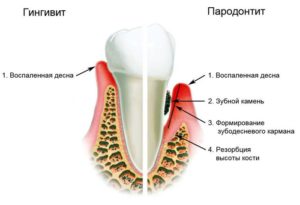 Гигиена полости рта